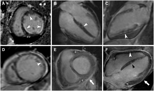 Different patterns of late gadolinium enhancement (LGE) in patients with eosinophilic granulomatosis with polyangiitis (EGPA)