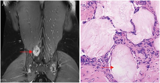Manifestations of lumbar gout entrapment in the erector spinae muscle