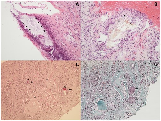 Histopathology of the synovial sample