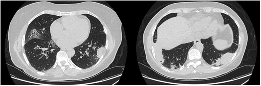 Pulmonary involvement: CT images performed in December 2020 before bronchoscopy