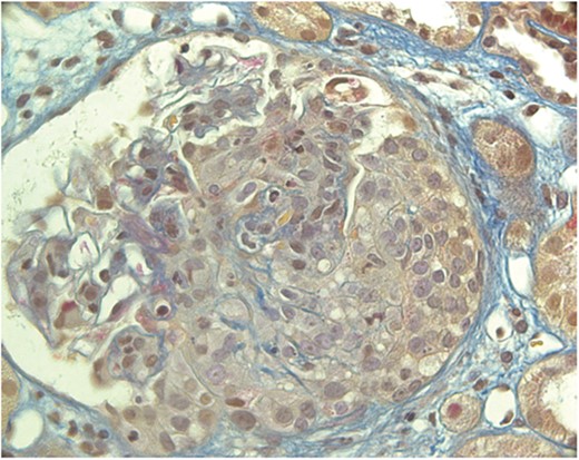 Kidney biopsy (Acid Fuchsin Orange G stain). The glomerulus shows a large, almost circumferential cellular crescent. Part of the Bowman capsule is disrupted