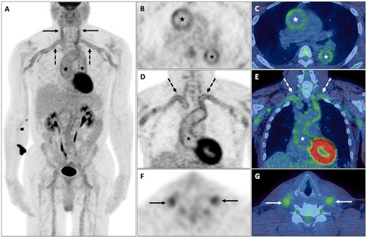 Large vessel vasculitis
