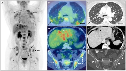 Sarcoidosis