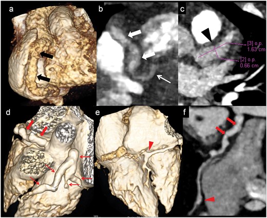 Proximal coronary artery with contiguous distal extension of aneurysms and branch vessels involvement
