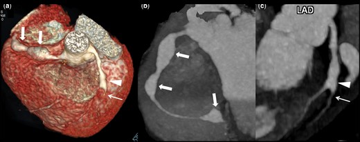 Aneurysms in proximal and distal segments but not in contiguity with branch vessels involvement and complications