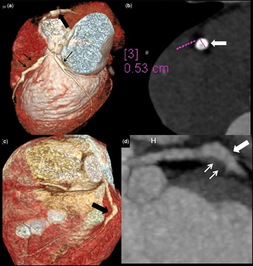 Distal CAA in presence of proximal involvement of some other coronary artery and complications