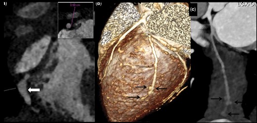 Isolated distal CAA without involvement of any other coronary artery