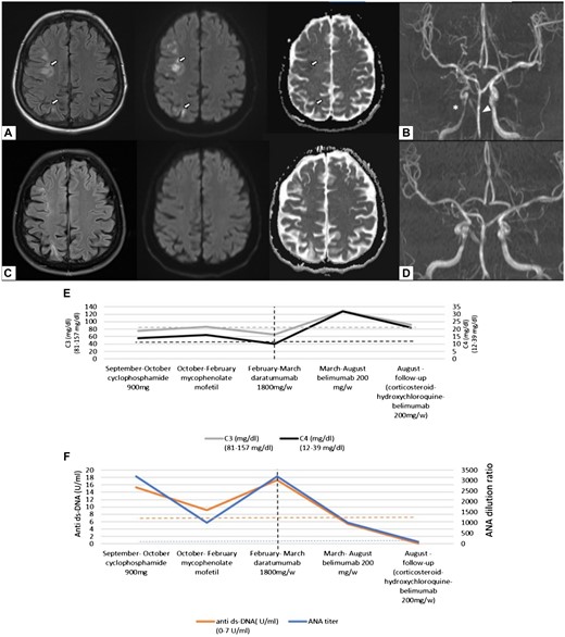 Cranial MR imaging and serological changes after plasma cell targeting of SLE