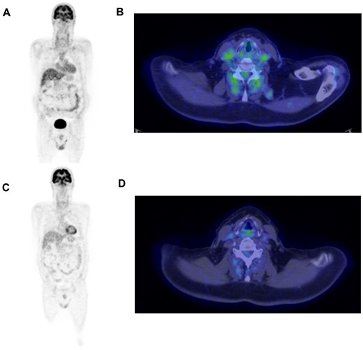 18F-FDG PET/CT scan at disease onset and after 3 years