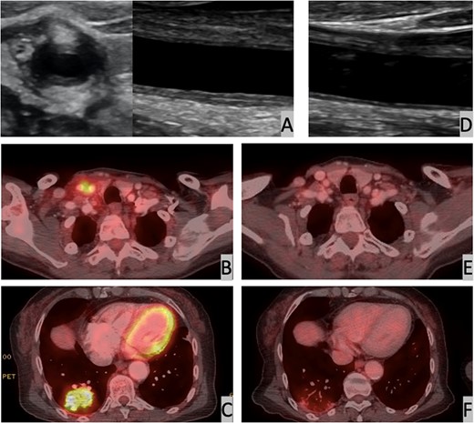 Ultrasound and PET-CT images of the carotid wall and lung