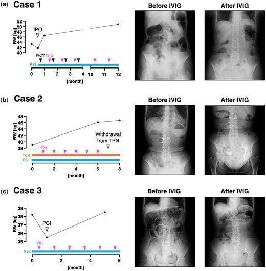 Clinical course of the three presented cases. The longitudinal change of the patients’ body weight (BW), abdominal X-ray findings at each time point of BW measurement, and the therapeutic regimen is shown. IPO: intestinal pseudo-obstruction; IVCY: intravenous cyclophosphamide; PCI: pneumatosis cystoides intestinalis; PSL: prednisolone; TCR: tacrolimus; TPN: total parenteral nutrition