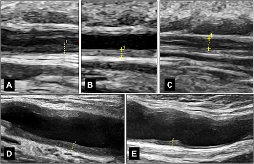 IMT measurements of temporal and axillary arteries in GCA. (A) shows the hypoechoic wall swelling of the frontal branch in a patient newly diagnosed with GCA, with an IMT of 0.60 mm. (B) displays the hyperechoic wall thickening of the parietal branch in a patient in remission, with an IMT of 0.49 mm. (C) illustrates the measurement of the frontal branch in acute GCA with compression, particularly in cases where a single wall measurement is difficult, with an IMT of both walls equal to 0.91 mm, or a single wall equal to 0.455 mm. (D) shows an axillary artery in a newly diagnosed patient, with an IMT of 1.21 mm. (E) depicts an axillary artery with chronic changes in remission, with an IMT of 0.88 mm. All images were captured using a GE Logiq E10 with a 6–24 MHz hockey stick probe (GE Healthcare, Chicago, IL, USA)