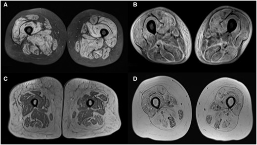 (A) STIR sequence showing muscle oedema in anterior medial and posterior compartments. (B) STIR sequence showing fascial oedema predominantly in posterior compartment. (C) T1-weighted sequence showing muscle atrophy in anterior medial and posterior compartments. (D) T1-weighted sequence showing fatty infiltration in anterior medial and posterior compartments