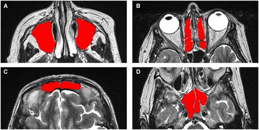 Axial MRI images of a patient showing the four different pairs of sinuses that were manually segmented using the MRIcron software, and these region of interest masks were used for calculating the computational volumes. (A) Maxillary sinuses. (B) Ethmaid sinuses. (C) Frontal sinuses. (D) Sphenoid sinuses