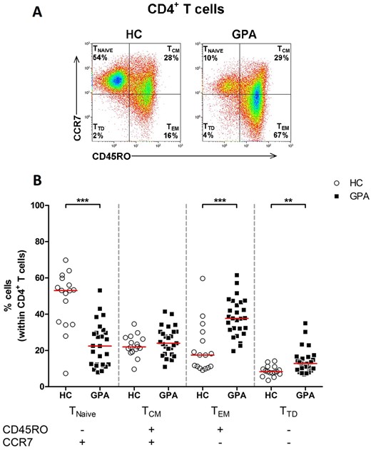 Increased percentage of circulating CD4+ TEM cells in patients with GPA. (A) Representative flow cytometry dot plots of CD45RO and CCR7 expression to identify four CD4+ T cell subsets in the peripheral blood of a patient with GPA in remission (right plot) and a HC (left plot). (B) Percentages of CD45RO–CCR7+ (TNAIVE), CD45RO+CCR7+ (TCM), CD45RO+CCR7– (TEM) and CD45RO–CCR7– (TTD) subsets within the CD4+ T cell population in peripheral blood of patient with GPA in remission (filled squares; n = 27) and HCs (open circles; n = 16). Horizontal bar represent median percentage. **P < 0.01, ***P < 0.001 vs HCs. GPA: granulomatosis with polyangiitis; HC: healthy control; TEM: CD4+ effector memory T cells