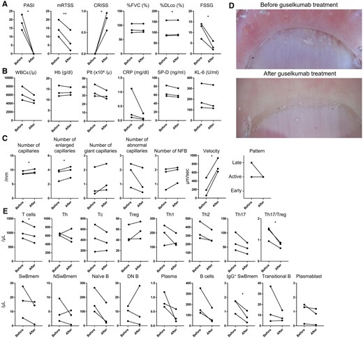 Changes in clinical findings, laboratory findings, and capillary abnormalities, and the profile of T and B cell subset analysis before and after guselkumab treatment. Changes in clinical findings (A), laboratory findings (B), and capillary abnormalities (C) before and after guselkumab treatment and their representative photographs (D). The transition of each T and B cell subset before and after guselkumab treatment (E). Spots represent each patient. Lines connecting dots represent changes in the same patient. PASI: psoriasis area and severity index; mRTSS: modified Rodnan total skin thickness score; CRISS: combined response index for SSc; %FVC: percentage predicted forced vital capacity; %DLco: percentage diffusion capacity of the lung for carbon monoxide; FSSG: Frequency Scale for the Symptoms of GERD; WBCs: white blood cells; Hb: haemoglobin; PLT: platelets; SP-D: surfactant protein D; KL-6: Krevs von den Lungen-6; NFB: nailfold bleeding; Th: helper T cells; Tc: cytotoxic T cells; Th1, type 1 helper T cells; Th2,:type 2 helper T cells; Th17: type 17 helper T cells; SwBmem: switched memory B cells; NSwBmem: non-switched memory B cells; DN B: double negative B cells. The combination of each cell surface marker is as follows; T cells: CD3+; CD4+ T cells: CD3+CD4+; CD8+ T cells: CD3+CD8+; Treg: CD3+CD4+CD25+CD127+; Th17: CD3+CD4+CCR6+CXCR3-; Th1: CD3+CD4+CCR6-CXCR3+; Th2: CD3+CD4+CCR6-CXCR3–; B cells: CD19+; switched memory B cells: CD19+IgD-CD27+; non-switched memory B cells: CD19+IgD+CD27+; naïve B cells: CD19+IgD+CD27–; DN B cells: CD19+IgD–CD27–; IgG+ class switched memory B cells: CD19+CD27+IgG+; plasmablast: CD19+CD20–CD38+; plasma cells: CD19+CD38+CD138+; transitional B cells: CD19+CD24+CD38+