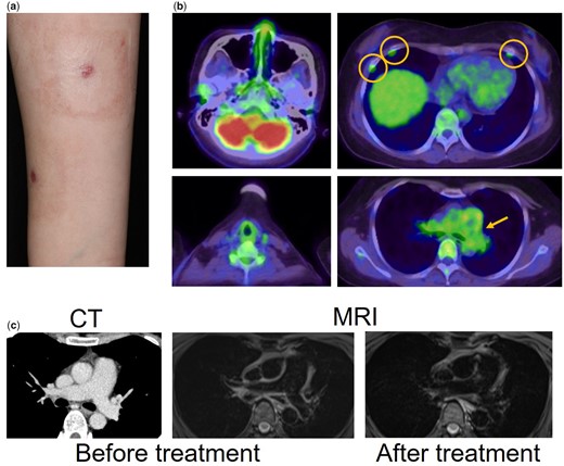 Clinical imaging of this patient. (a), Multiple pustular skin lesions at the injection site on her forearm. (b) Fluorodeoxyglucose (FDG)-PET scan. (c) The imaging of the pulmonary artery by CT, left and MRI, middle (T2WI). The imaging of the pulmonary artery using MRI obtained 2 months after discharge (right)