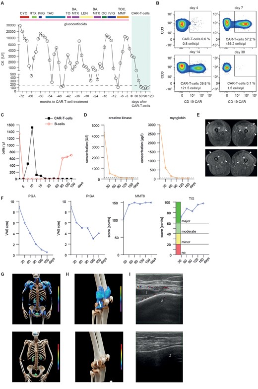 Effects of CD19 CAR-T cells therapy on the manifestations of antisynthetase syndrome (ASS). (A) Serum creatinine kinase (CK) levels during previous treatment regimens and after treatment with CD19 CAR-T cells. The horizontal dotted line indicates the upper limit of normal range (<170 U/l). (B) Dot plots showing circulating CD3 T cells (upper two quadrants) and CAR-T cells (upper right quadrant), quantified by fluorescence-activated cell sorting on days 4, 7, 14 and 30 after infusion. (C) Concentration of circulating CD19 CAR T cells and CD19+ B cells over time. (D) Concentrations of serum creatinine kinase (CK; left) and myoglobin (right). Dotted line indicates normal level (CK <170 U/l; myoglobin: <70 µg/l); (E) MRI showing treatment effects over the course of 3 months. Top shows axial T2-weighted fat suppressed MRI at baseline with marked oedematous symmetrical intramuscular signal alterations in the quadriceps muscles group on both sides consistent with active myositis, including the M. vastus lateralis (arrowheads), M. vastus medialis (arrow) and M. vastus intermedius (asterisks). Bottom shows follow-up MRI with complete resolution of signal changes and normalization of muscle signal in the same locations. (F) Disease activity assessed by physician global (PGA; left), patient global (PtGA; middle) and manual muscle testing score 8 (MMT8; right). Measurement of response as American College of Rheumatology/European League Against Rheumatism total improvement score (TIS) with cut-offs for major, moderate, minor or no response. (G) Cinematic rendering reformatted upper body FAPI-PET-CT scans showing significant mesenchymal activity in the muscles at baseline that is reduced after CAR-T cells treatment (bottom). (H) Cinematic rendering reformatted FAPI-PET-CT of knees showing a significant reduction in mesenchymal activity in the joints. White line demonstrates ultrasound device positioning. (I) Ultrasound examination of the knee joint showing effusion (1) related to lateral recessus bursitis at the distal femoral condyle (2; top) and its resolution after treatment (bottom). BA: baricitinib; CAR: chimeric antigen receptor; LEN: lenabasum; OC: ocrelizumab; RTX: rituximab; TAC: tacrolimus; TO: tofacitinib; TOC: tocilizumab