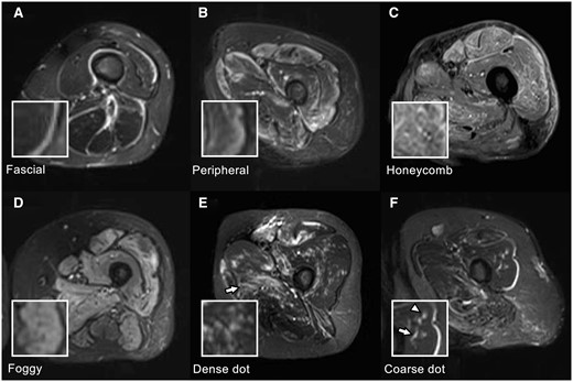 MRI findings in IIMs. All images are axial STIR images of the left thigh, and the small boxes in the lower left are magnified images of the corresponding MRI findings. (A) Fascial pattern: Linear HSI localises to the fasciae. Fascial patterns can be distinguished from chemical shift artefacts, generally localised to only one side of the fasciae. (B) Peripheral pattern: HSI areas are observed in the marginal zone of the muscles, and the signal intensity continuously decreases inward. (C) Honeycomb pattern: HSI areas are mainly observed in the rectus femoris and vastus lateralis with reticular HSI. (D) Foggy pattern: Relatively homogeneous HSI areas are observed in the muscle parenchyma. In this case, HSI areas occupy >50% of muscle parenchyma, and the distribution is diffuse. (E) Dense dot pattern: punctate HSI is densely clustered in the muscle parenchyma. A patchy honeycomb pattern is also observed in the adductor magnus (arrow). (F) Coarse dot pattern: Punctate HSI is sparsely scattered in the muscle parenchyma (arrowhead). The adjacent linear HSI (arrow) represents a small vessel and can be traced in continuous axial sections (image not shown). IIMs: idiopathic inflammatory myopathies; STIR: short TI inversion recovery