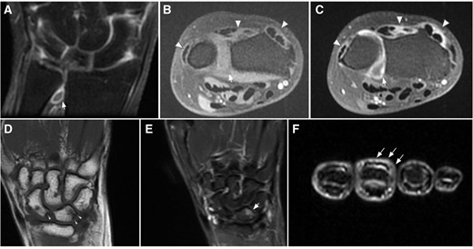 Selected images MR images from different patients covering the spectrum of positive findings. (A–C) Grade II synovitis of the distal radio-ulnar joint and active tenosynovitis from 2° to 6° extensor compartments. (A) Coronal T1FatSat after IV contrast administration. (B) Axial T1FatSat pre-contrast. (C) Axial T1FatSat after contrast administration. Note the active enhancement in the synovium of the joint (arrows), and tendon sheaths (arrowheads) after IV contrast administration. (D–E) Grade 1 erosions and grade II bone marrow oedema. (D) Coronal T1WI, depicting small erosions at the proximal aspect of the scaphoid and lunate (arrowheads). (E) Coronal STIR, shows associated bone marrow edema (arrow). (F) Axial STIR image at the level of the middle phalanges, showing extensor peritendinous edema (peritendinitis) in the third finger (tailed arrows)