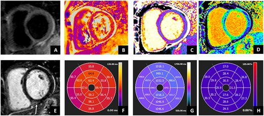 Cardiac MRI in patient with anti-synthetase syndrome. Cardiac MRI shows ventricles with normal volumes and function. STIR images showed (A) absent focal oedema, but subtle diffuse oedema as showed by (B) T2 mapping and (F) AHA bullseye (global value 58 ms; normal value ≤50 ms). (E) Late gadolinium enhancement showed mid-wall hyperintensity in the basal posterior septum, associated with normal native T1 mapping (C and G) (1037 ms; normal value <1045 ms) but increased ECV values (D and H) (29%, normal values <27%), as for mild increase in interstitial fibrosis. Moreover, mild pericardial effusion was evident without significant increase in the pericardium thickness. AHA: American Heart Association; STIR: Short-tau Inversion Recovery; ECV: extracellular volume