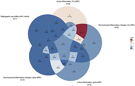 Imaging features of axial involvement in patients with psoriasis diagnosed with axPsA. This five-entry Venn diagram represents the distribution of radiological features on axial imaging in the ATTRACT (Axial psoriaTic arThritis scReening AnCona iTaly) patients diagnosed with axPsA. Every piriform figure represents one of the five main features of axPsA imaging: radiographic sacroiliitis as per mNY criteria at the upper left corner, active inflammation on MRI of SIJ at the top, structural post-inflammatory changes on MRI of SIJ at the upper right corner, active inflammation on MRI of the spine at the bottom right and structural post-inflammatory changes on MRI of the spine at the bottom left. The radiological overlap of the five features is represented by the overlap of each figure with the others, in every possible combination. In every section of each figure (overlapping or non-overlapping with the others) is shown the number (%) of patients affected by that feature(s). The percentage of patients is also scaled according to the colour legend on the right (blue for the lowest, red for the highest). It could be observed that the highest percentage of patients present both active and structural post-inflammatory changes in the SIJ, as represented by the red overlapping section between the top and upper right corner figures. A consistent proportion of patients presented spine involvement (bottom figures) without an active SIJ inflammation on MRI or a radiographic sacroiliitis; such patients did not fulfill the ASAS classification criteria for axSpA. The patient with only structural post-inflammatory changes on MRI without any other radiological feature (top right corner) was diagnosed with axPsA because of HLA-B27 positivity (‘clinical branch’). axPsA: PsA with axial involvement; mNY: modified New York; SIJ: sacroiliac joint