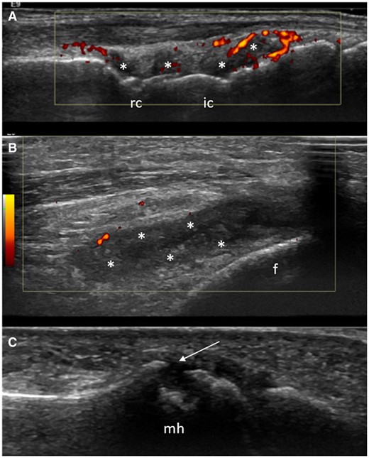 US synovitis and/or bone erosions in the three joints included in the ‘clinical-US short’ model (wrist, knee and MTP5 joint) in three different CCP+ at risk individuals. (A) Synovial hypertrophy (asterisks) and power Doppler (red spots) in the radiocarpal (rc) and intercarpal (ic) joints. (B) The presence of synovial hypertrophy (asterisks) and minimal power Doppler signal (red spots) in the lateral recess of the knee joint. (C) A large bone erosion (arrow) in the lateral aspect of the fifth metatarsal head (mh). f: femur