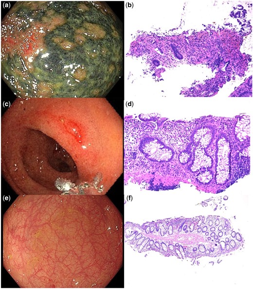 (A) Endoscopic image of necrotic rectal ulceration from the initial colonoscopy and (B) corresponding histopathology showing an ischaemic colitis pattern of injury with erosion, hyalinization of the lamina propria and superficial crypt withering. (C) Endoscopic image of the area of previous necrotic ulceration at the second colonoscopy and (D) corresponding histopathology showing erosion, crypt architectural distortion indicating chronicity and prominent crypt apoptotic bodies. (E) Endoscopic image of the area of previous necrotic ulceration with complete macroscopic resolution and (F) corresponding histopathology showing mild crypt architectural distortion only