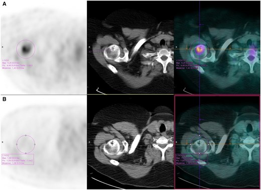 Hypermetabolic and osteolytic bone lesion of the proximal humerus on 18F-FDG PET/CT in a patient with sarcoidosis (A) before and (B) after treatment with infliximab. Left: 18F-FDG PET; middle: CT; right: 18F-FDG PET/CT