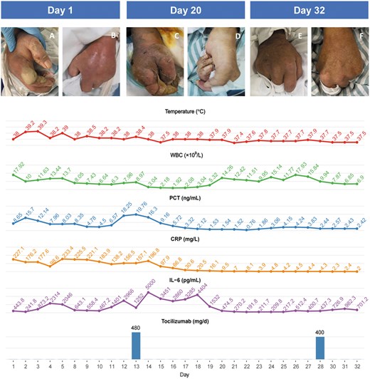 Edit Filter Menu Options Tocilizumab for severe gout-induced septic-like syndrome in the ...