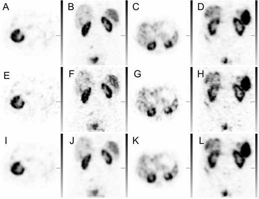 Representative 111In-octreotide SPECT reconstructions from four patients: 120P ASCC–SPECT (A–D), 30P ASCC–SPECT (E–H) and 30–120SIP ASCC–SPECT (I–L).