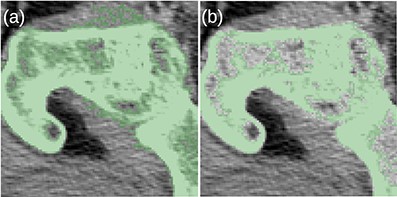 (a) The MK2014v2 algorithm misclassified the muscle attached to the bone. (b) This problem was mitigated by the JJ2016 algorithm.