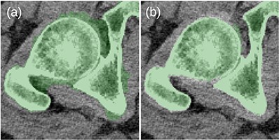 (a) Problems with the 2D-based hole filling in MK2014v2. (b) The 3D-based hole filling in JJ2016 gave better results.