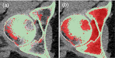 (a) Unwanted connection between the head of the femur and the pelvic bone in JJ2016 (red pixels). (b) Resulting incorrect hole filling of the region between the two bones (red pixels).