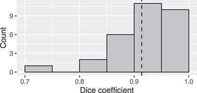 Frequency distribution of Dice coefficients for the 30 patients.