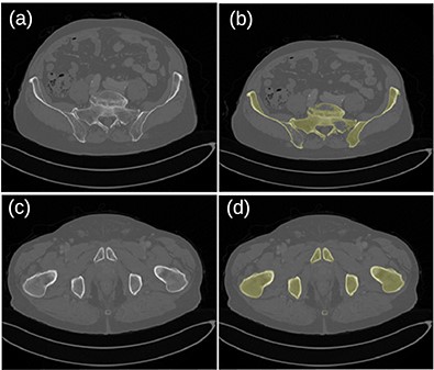 Original images (a, c) and segmented bone (b, d) for the patient dataset 26. A hole in the left pelvic bone is not correctly filled in the top-right image.