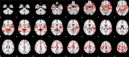 Whole-brain fMRI regression analyses in which neural activity from the retaliatory > non-retaliatory aggression contrast was regressed onto participants’ retaliatory aggression scores.