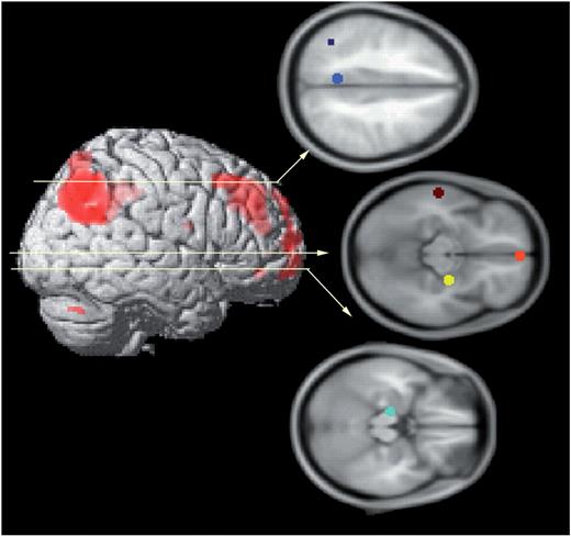 Six regions were included in the anatomical model; these regions were selected based upon prior studies of autobiographical memory retrieval (e.g. Maguire et al., 2001; Sharot et al., 2007). Regions included medial parietal cortex (encroaching upon posterior cingulated cortex and precuneus; center of ROI = −6, −50, 37; in blue), left temporoparietal junction (center of ROI = −40, −56, 43; in navy), medial PFC (center of ROI = 2, 55, −13; in orange), lateral middle temporal lobe (center of ROI = −60, −22, −10; in brown), right amygdala-hippocampal complex (center of ROI = 26, −12, −11; in yellow), and left hippocampus (center of ROI = −14, −18, −18; in turquoise).