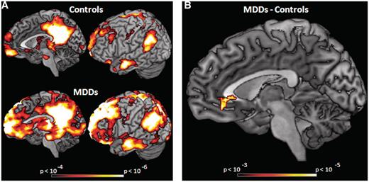 (A) Default-network connectivity for MDDs and HCs during fixation periods defined by connectivity with posterior-cingulate cortex, x = −7, y = −45, z = 24. Correlations >0.25 (P < 0.001) are displayed. (B) Results of a two-sample t-test comparing MDDs’ and HCs’ default-network connectivity during fixation periods. MDDs show more connectivity in the subgenual-cingulate than HCs (P < 0.05 corrected; peak at x = 0, y = 38, z = −9; 46 voxels).