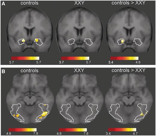 T-maps showing voxels in the amygdala (A) and the fusiform gyrus (B) with a t-value above threshold (P < 0.05, FWE corrected for multiple comparisons) during untrustworthy judgments of faces in the control group and XXY group.