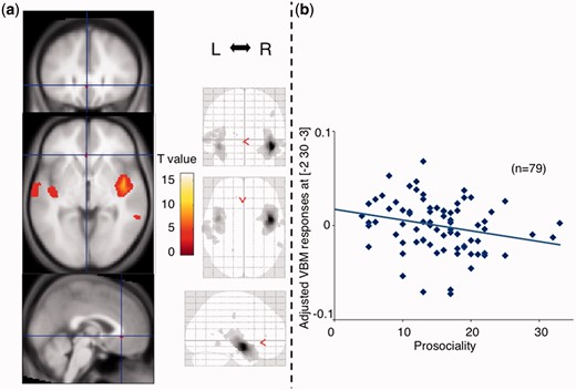 The right insula structural coupling with the ACC and its relationship to ‘prosociality’. (a) Grey matter regions showing significant correlations with intensity in the right insula were rendered in the MNI space (n = 135) (voxel threshold: uncorrected P < 0.001). L, left; R, right. (b) Scatter plots depicting correlations between the coupling of the right insula with anterior cingulate and ‘prosociality’ in males, indicating that subjects with weak relationship between these two structures have highly autistic traits in the social domain.