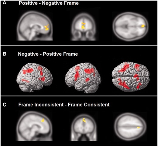 (A) Shown at the overall group level are regions involved in evaluating positively framed items over negatively framed items. This contrast resulted in a majority of regions that have been associated with reflexive processing. (B) The reverse contrast of negatively framed minus positively framed items elicited greater activation within reflective processing regions in lateral prefrontal and parietal cortex among other areas. (C) Region of the ACC associated with frame inconsistent responses and reflective processing.