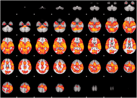 Global brain activity during prosodic processing across tasks at the threshold Puncorr < 0.001.