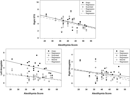 Alexithymia correlations with ROI activity in response to angry, surprised and neutral prosody vs baseline across tasks. Top panel: Negative correlation of alexithymia with activity of the right STG. Bottom panel: Negative correlation of alexithymia with the left and right amygdala.