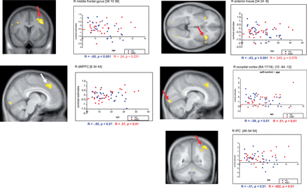 Covariation of brain activation and age. Statistical parametric maps of significant differences in covariation of brain activation with age (with respect to group) during the self task (see Methods section for details). SPMs are thresholded at P < 0.005 (voxel level, uncorrected) and overlayed on a mean anatomical T1 image of all participants. Depicted clusters (red arrows) were significant at the whole brain level ( P < 0.05, cluster-level corrected for multiple comparisons), except for the peak in the MPFC ( P < 0.05, voxel level corrected for multiple comparisons (ROI), white arrow). Correlation plots depict individual contrast estimates for the self task as a function of age in the activation peak. Correlation coefficients (R) and linear best fit estimates are given separately for each group (blue = TDC; red = individuals with ASD).