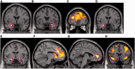  fMRI data showing activations related to the proposals, stake level, rejection and acceptance . (A) Proposals vs non-proposals in the real group, compared with the hypothetical group, yielded a higher activation in amygdala ([−28 0 −24] Z = 2.98, P = 0.042 voxel-level corrected). (B) Low stakes vs high stakes in the real group, compared with the hypothetical group, resulted in greater amygdala activation ([34 4 −20] Z = 2.79, P = 0.070 voxel-level corrected) and (C) dlPFC activation ([−26 42 20] Z = 3.45, P = 0.010 cluster-level corrected). (D) In the real group, compared with the hypothetical group, both rejected proposals, and (E) accepted proposals generated higher amygdala activity (rejected: [−26 −2 −24] Z = 3.32, P = 0.016 voxel-level corrected, accepted: left amygdala: [−20 −6 −18] Z = 2.91, P = 0.056 voxel-level corrected; right amygdala: [22 −4 −16] Z = 2.88, P = 0.060 voxel-level corrected). (F) In addition, accepted proposals in the real group resulted in greater activations in the ventral caudate ([−10 22 −6] Z = 4.03, P = 0.084 voxel-level corrected), and left ACC ([−10 22 30] Z = 4.59, 0.014 cluster-level corrected). (G) Subjects in the real group who accepted most donation proposals activated rACC ([ − 4 50 2] Z = 3.66, P = 0.037 cluster-level corrected) the strongest. (H) Insula activity ([−42 18 −14] Z = 3.94, P = 0.011 cluster-level corrected) was higher in the real group, compared with the hypothetical group, when participants viewed pictures that they later accepted. 