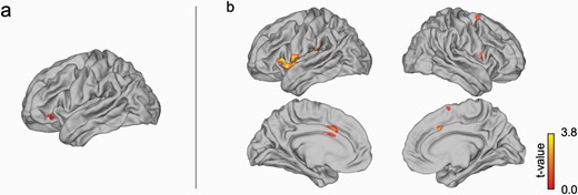For the instructed fear stimuli, (a) left lOFC showed a stronger functional connectivity in the contrast [(iCS+ vs. iCS−) with (b) caudal ACC and insula as a part of the functionally defined “fear network” for the hDP group than the lPD group.
