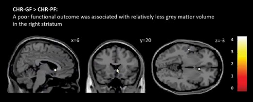 Differences between clinical high risk individuals with poor overall functioning (CHR-PF) and those with good overall functioning (CHR-GF). The CHR-PF group had less grey matter volume than did CHR-GF in the right striatum (P < .05 FWE-corrected). Effects are displayed at P < .001 uncorrected for illustration purposes. T-values are indicated by color bars (for color figure refer to online version).