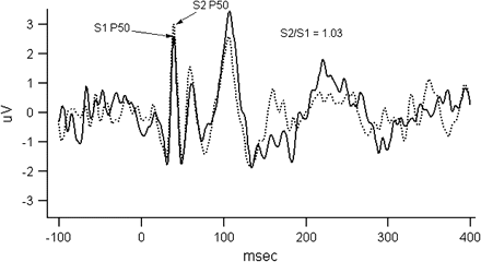 The figure illustrates P50 gating measure. Evoked potential responses to S1 (solid line) and S2 (dashed line) stimuli are overlaid in the figure for illustrative purposes. Subject was presented with 150 trials of paired clicks (S1 and S2) 500 ms apart; the intertrial interval was 10 s. The figure gives averaged data across all trials that were not rejected because of artifacts. P50 amplitudes were measured by the absolute differences between the positive peak and the preceding negative trough occurring near 50 (operationally, S1 amplitude is within 35–70 ms of stimulus, and S2 within a window of the S1 latency ± 10 ms for the subject). As one can see, the S2 amplitude was not reduced in this schizophrenia subject with S2/S1 ratio being about 1 suggesting failure to gate.