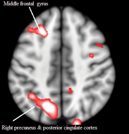 Comparison of blood oxygen level-dependent activation in patients with schizophrenia and control subjects during approachability judgments. Greater activation of precuneus and middle frontal gyrus in the patient group.